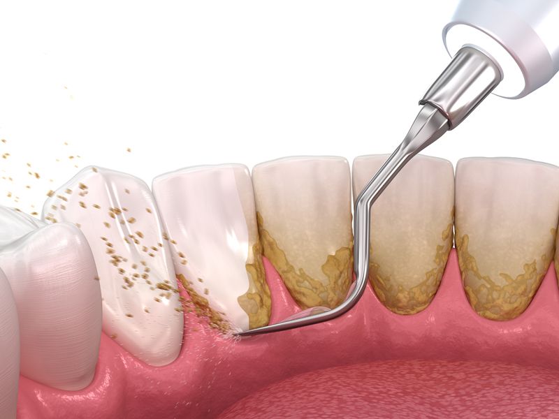 Professional teeth cleaning and polishing