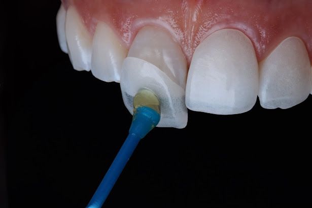 Cosmetic dental veneers treatment in Sylhet